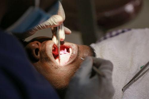 Tooth Extractions
