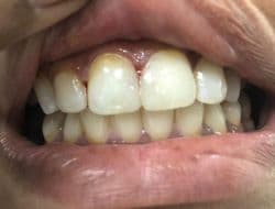 Tooth Restorations & Fillings