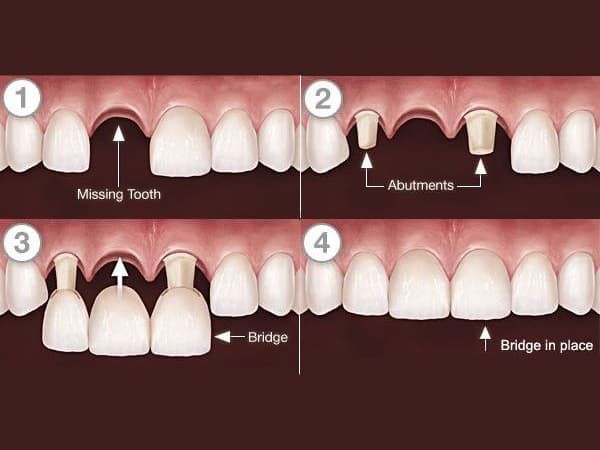 Crowns, Bridges & Dentures