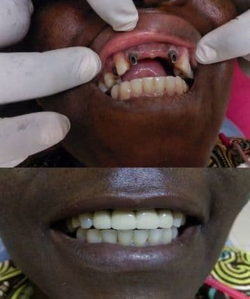 Dental Implants