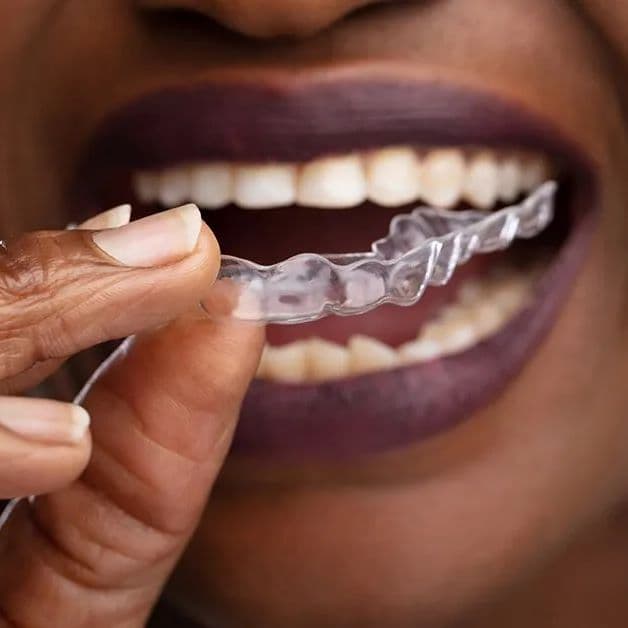 Invisalign clear aligners at Donau Dental Center
