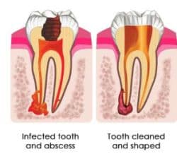 Root Canal Treatment